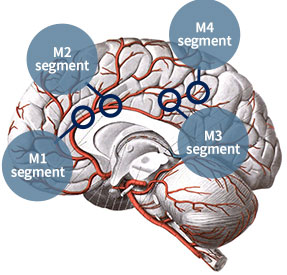 Segments of the middle cerebral artery